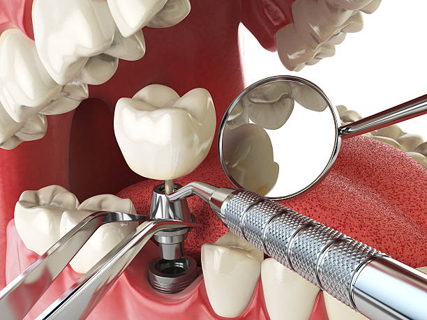 Best Emergency Tooth Extraction in Liberty, TX